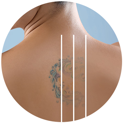 Laser Tattoo